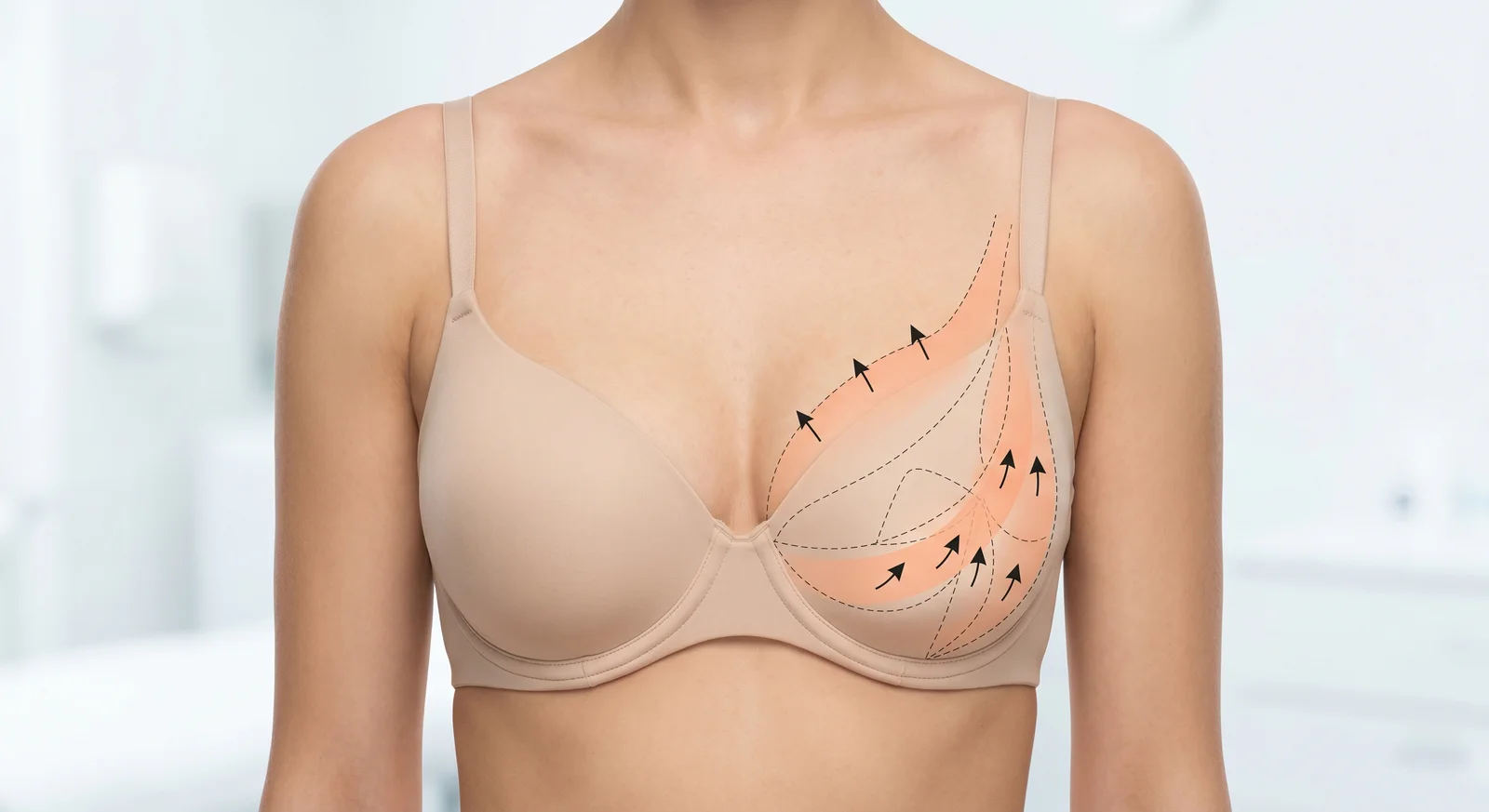 Illustration of the Bellesoma technique — internal tissue rearranged and lifted higher on the chest