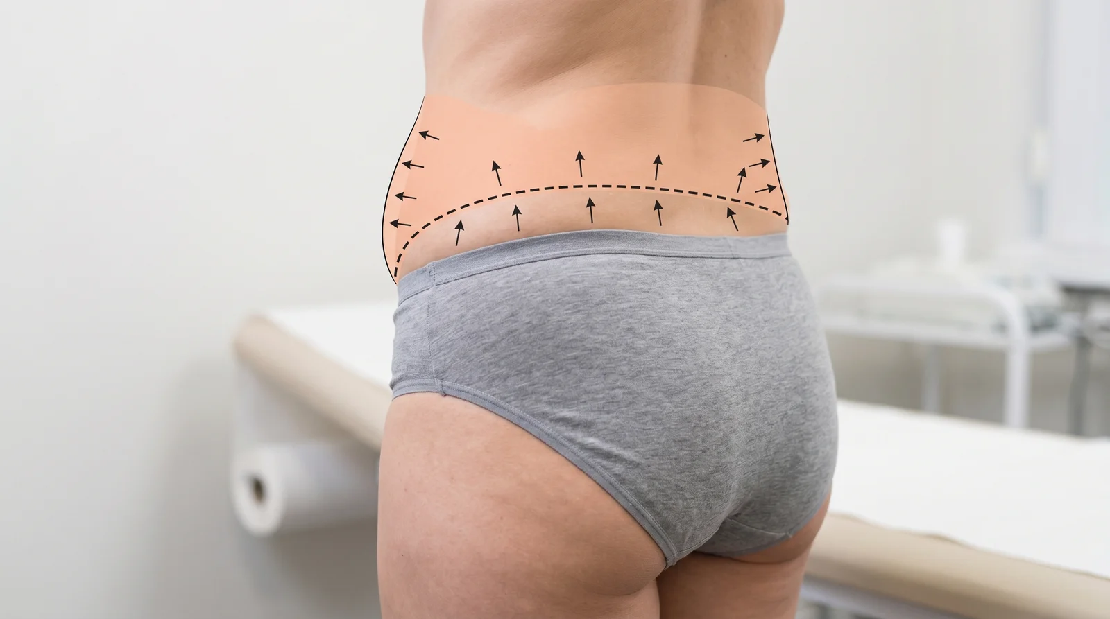 Illustration of the circumferential body lift — the incision encircles the body