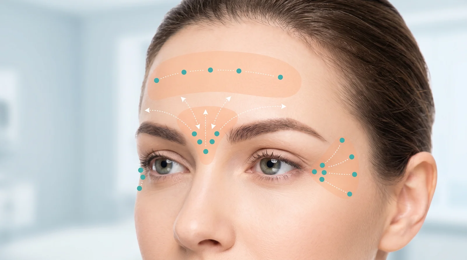 Illustration of Botox® injection points — forehead, glabella, and crow's feet