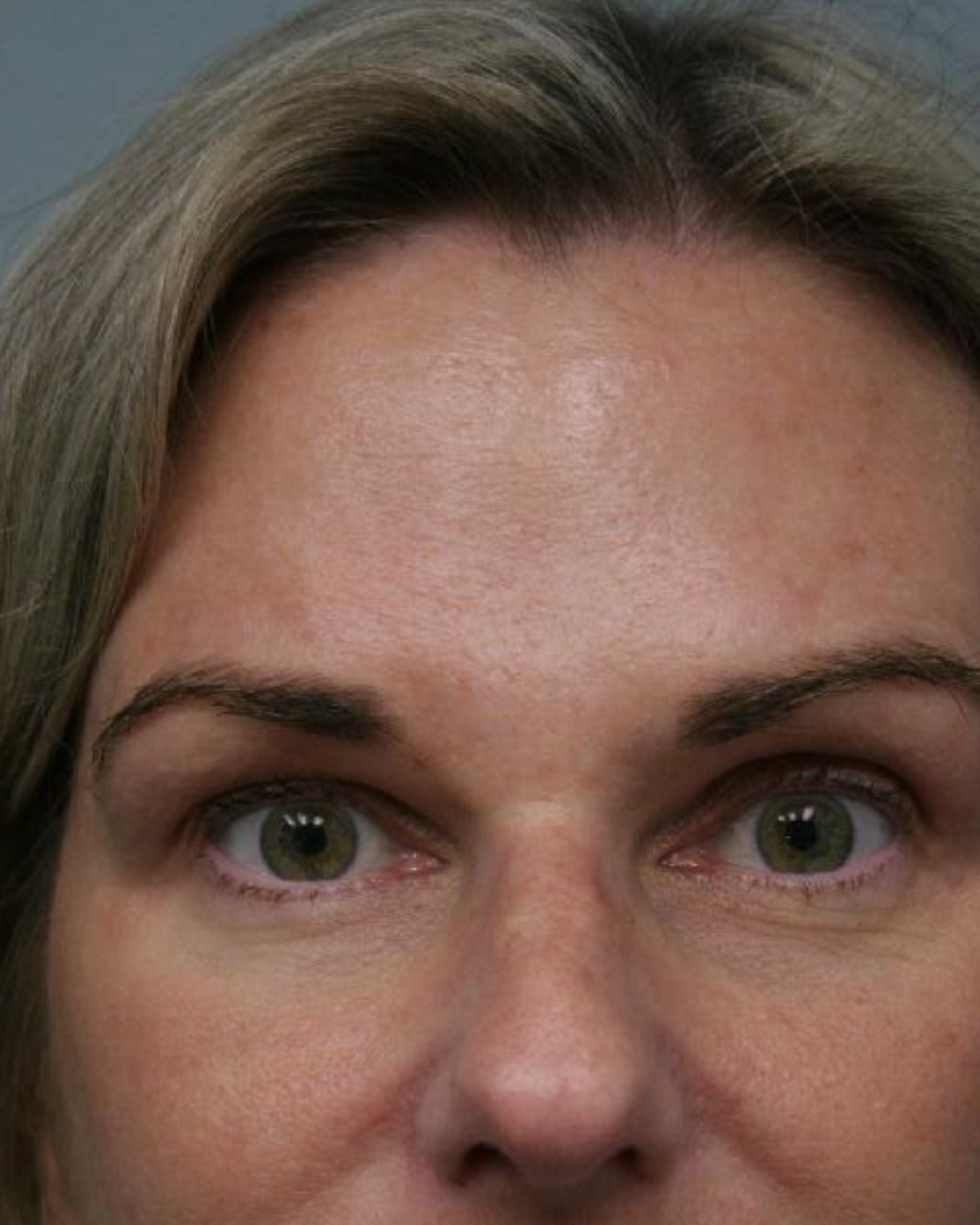 After — Endoscopic Brow Lift