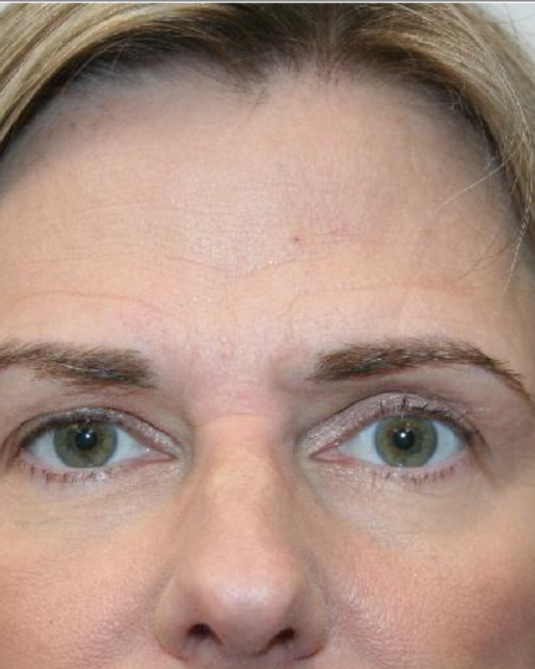 Before — Endoscopic Brow Lift