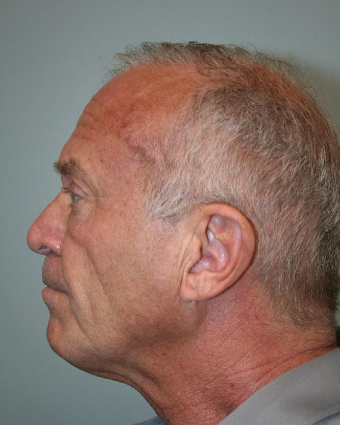 Before — Deep Plane Facelift, left view