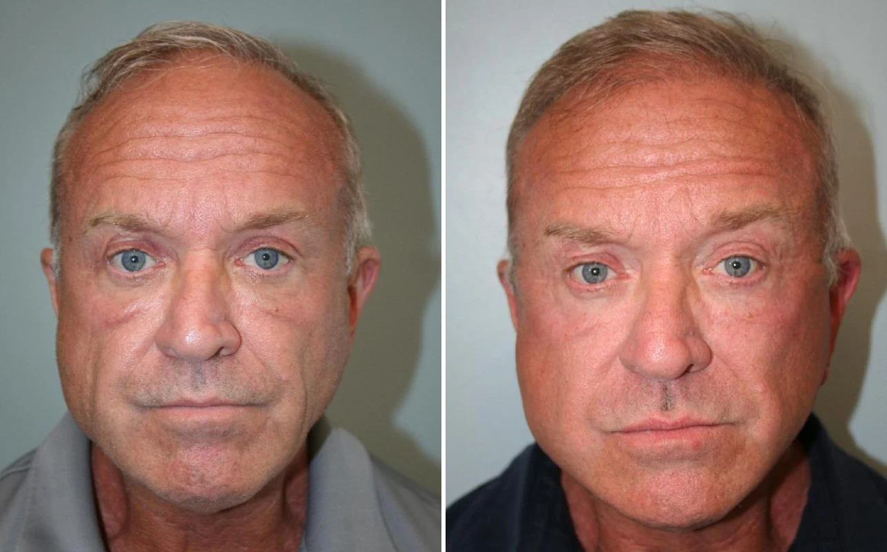 Before and after — Deep Plane Facelift, front view