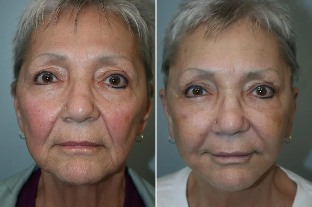 Before and after — Deep Plane Facelift and Neck Lift, front view
