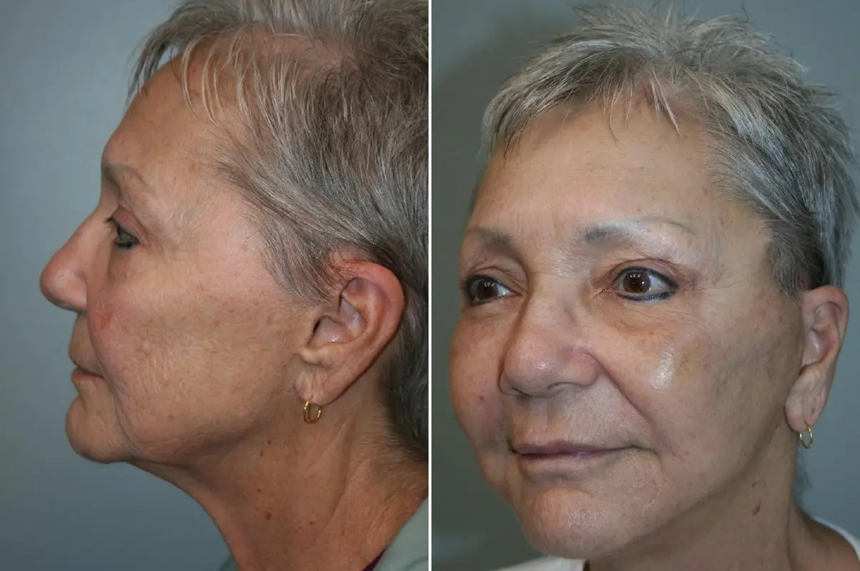 Before and after — Deep Plane Facelift and Neck Lift, left oblique view