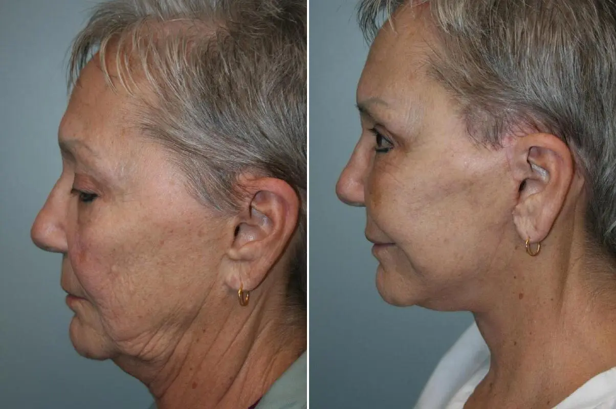 Before and after — Deep Plane Facelift and Neck Lift, neck and jawline detail