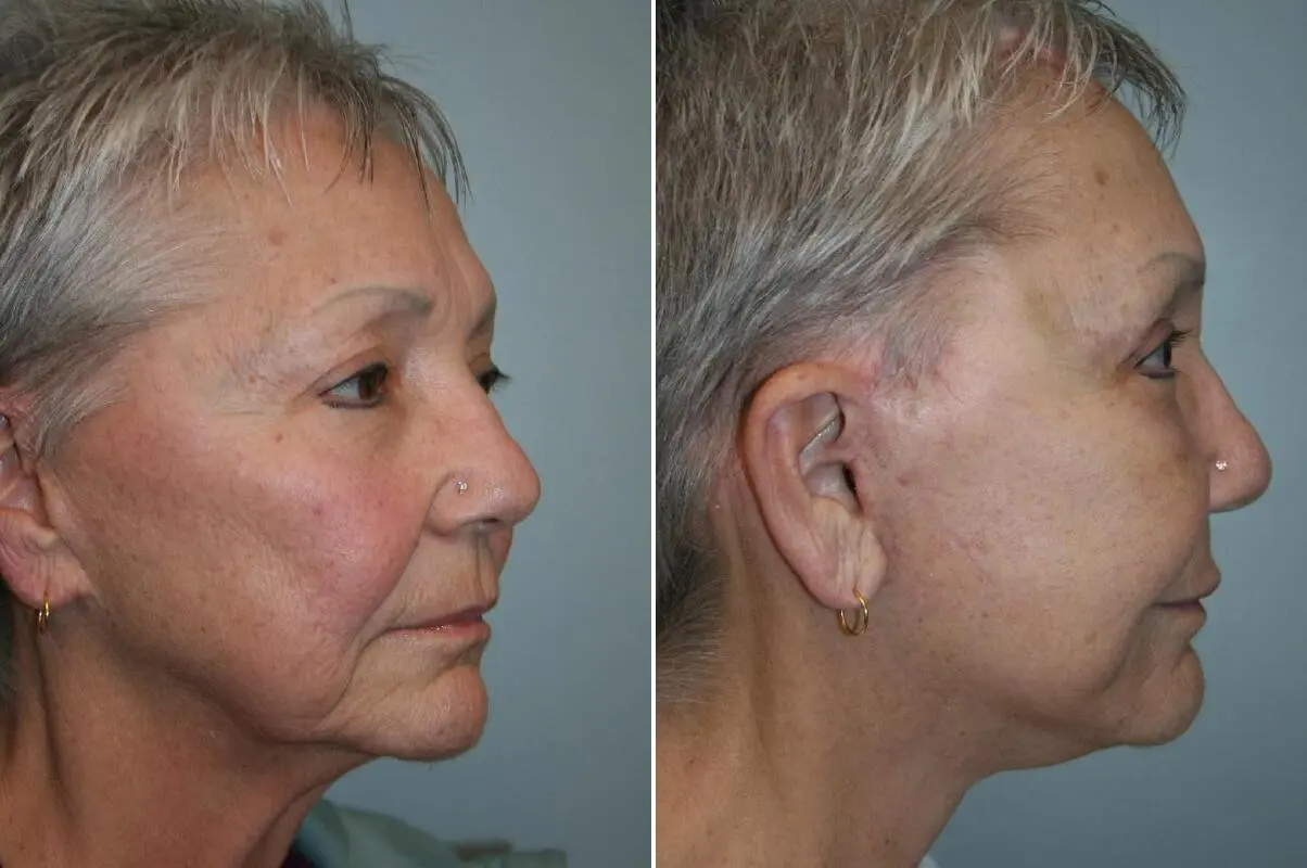 Before and after — Deep Plane Facelift and Neck Lift, right profile view
