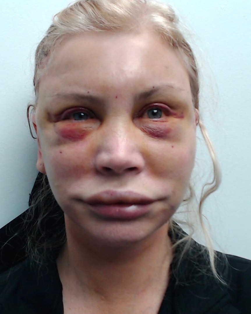 3 days post-op — Deep Plane Facelift, front view