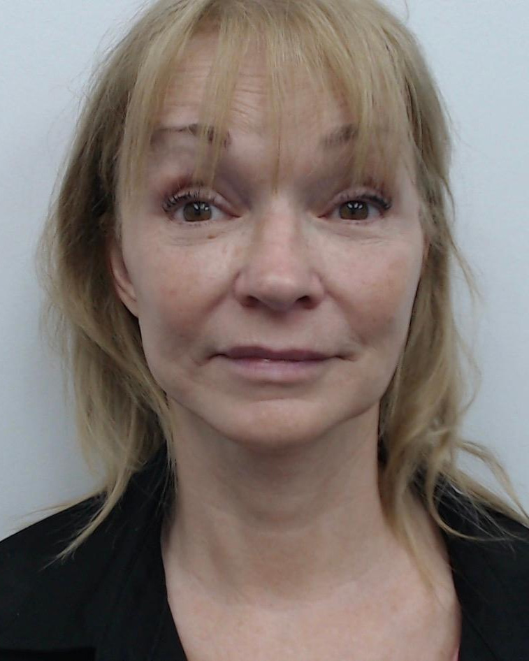 After — Deep Plane Facelift and Neck Lift, front view