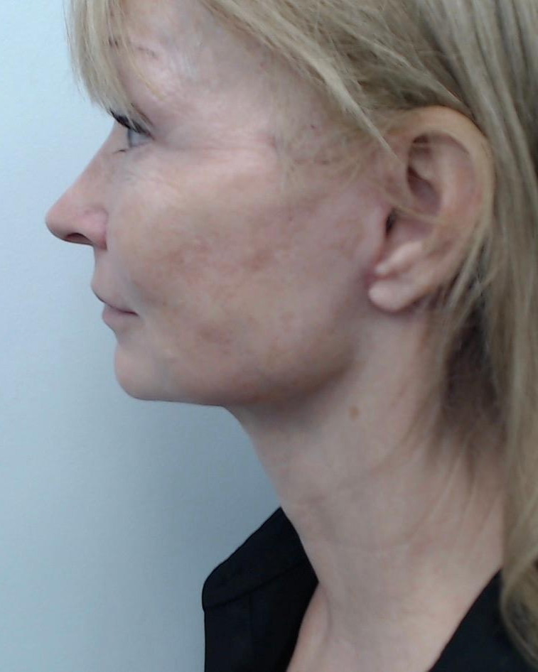 After — Deep Plane Facelift and Neck Lift, left view