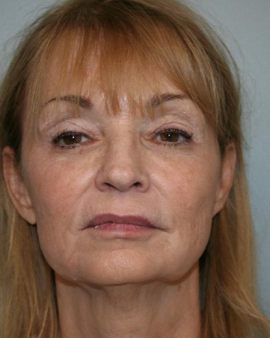 Before — Deep Plane Facelift and Neck Lift, front view