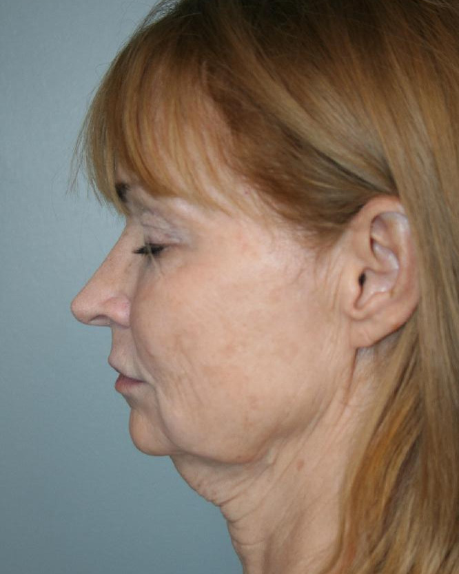 Before — Deep Plane Facelift and Neck Lift, left view