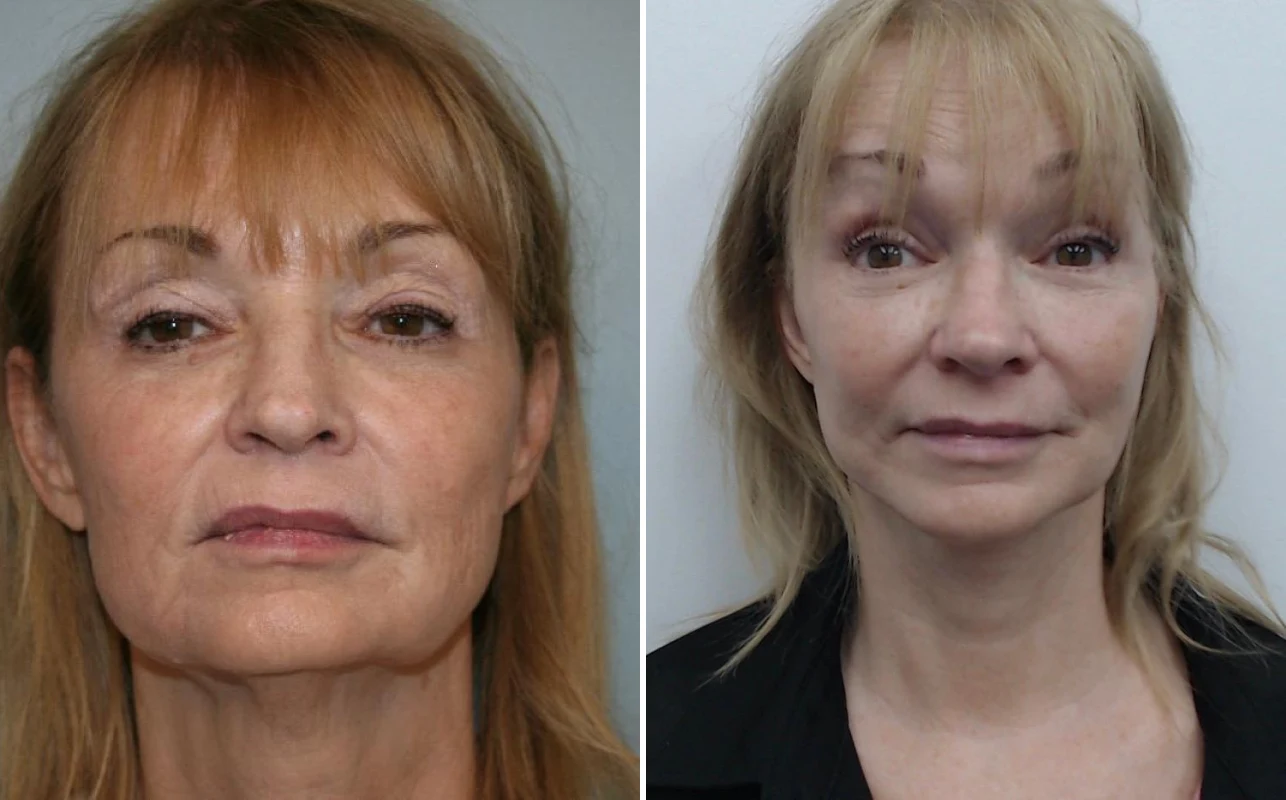 Before and after — Deep Plane Facelift and Neck Lift, front view