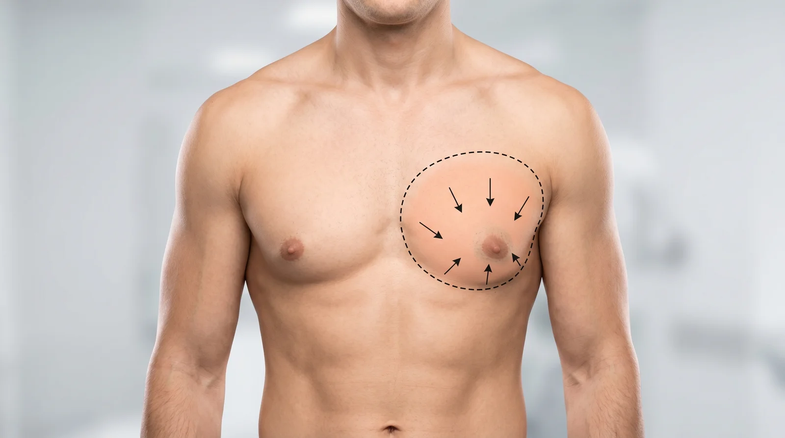 Illustration of gynecomastia — excess chest tissue marked for removal and contouring