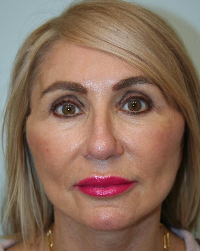 After — Optimum LIFT™ with neck liposuction, front view