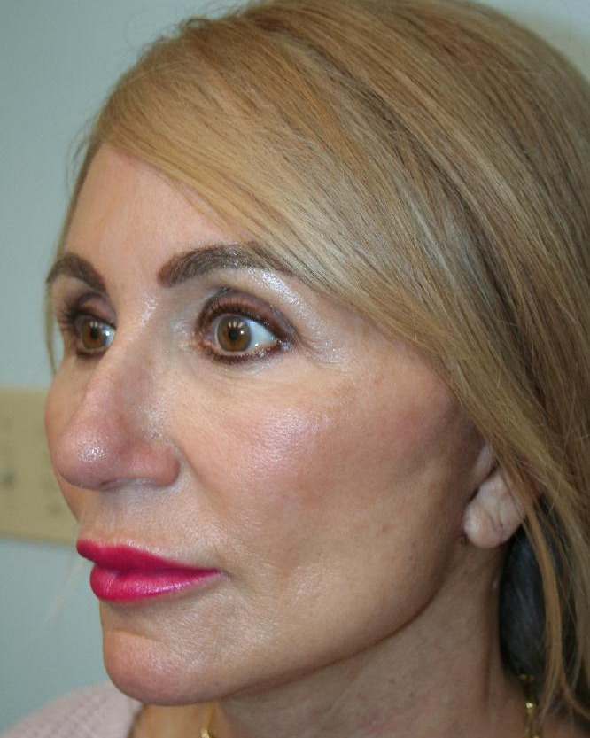After — Optimum LIFT™ with neck liposuction, left view