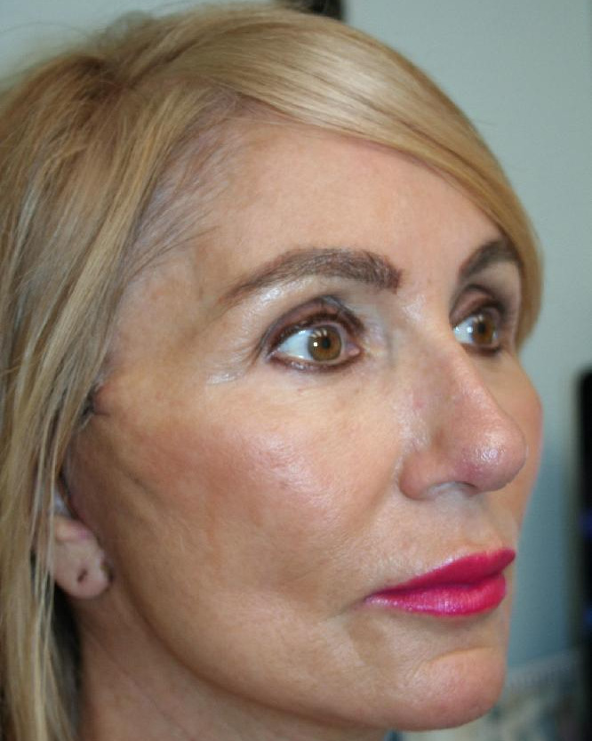 After — Optimum LIFT™ with neck liposuction, right angle view