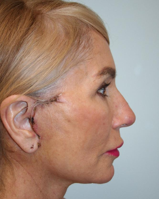 After — Optimum LIFT™ with neck liposuction, right view