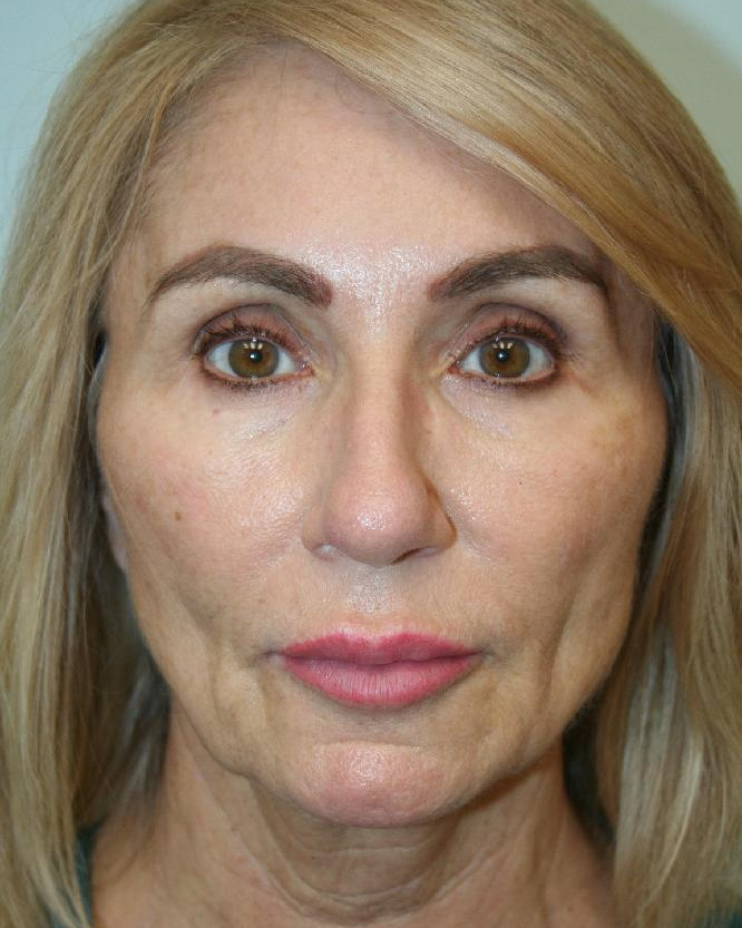 Before — Optimum LIFT™ with neck liposuction, front view