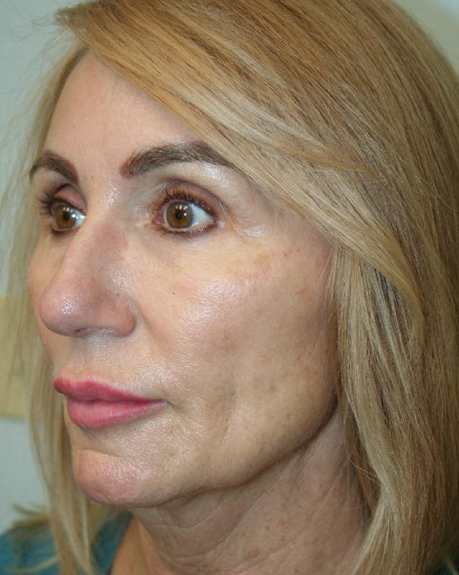 Before — Optimum LIFT™ with neck liposuction, left view