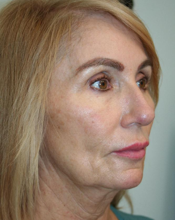 Before — Optimum LIFT™ with neck liposuction, right angle view