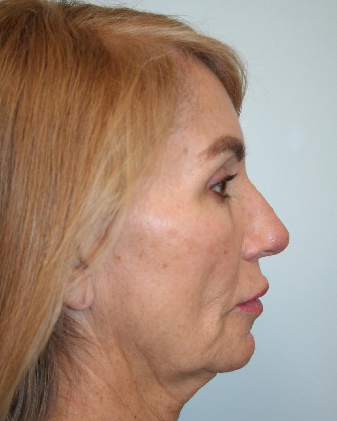 Before — Optimum LIFT™ with neck liposuction, right view