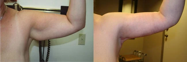 Before and after — Brachioplasty