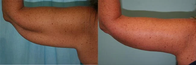 Before and after — Brachioplasty