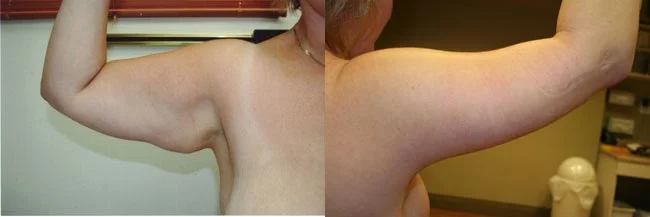 Before and after — Brachioplasty