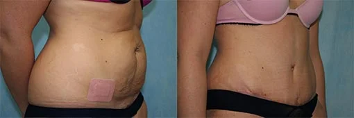 Before and after — Abdominoplasty