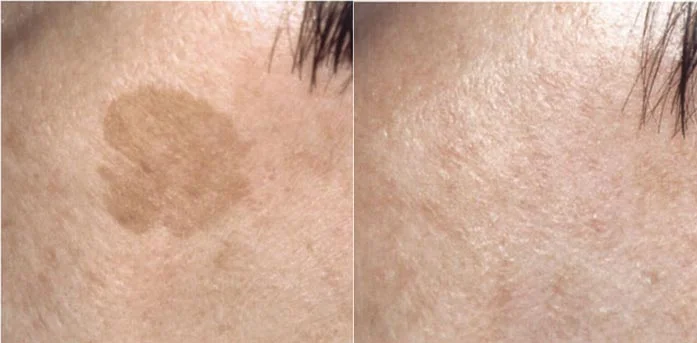 Before and after — Laser Resurfacing
