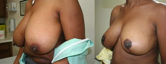 Before and after — Breast Reduction