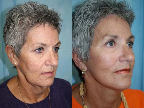 Before and after — Optimum LIFT™