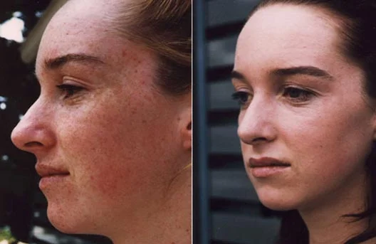 Before and after — Laser Resurfacing