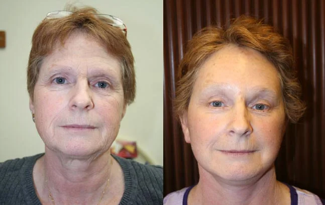 Before and after — Brow Lift