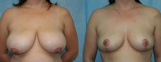 Before and after — Breast Reduction