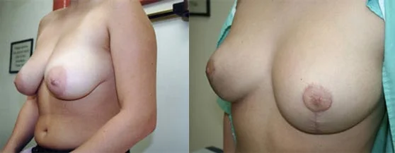 Before and after — Breast Reduction