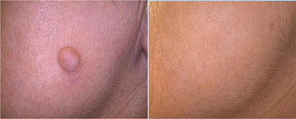 Before and after — Laser Resurfacing