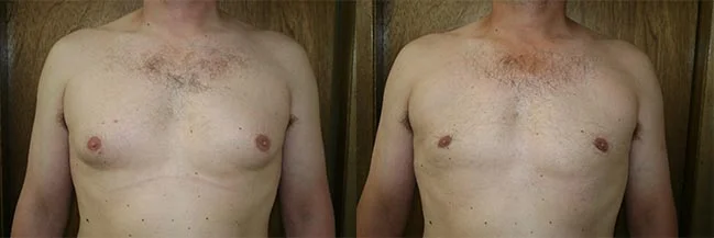 Before and after — Gynecomastia