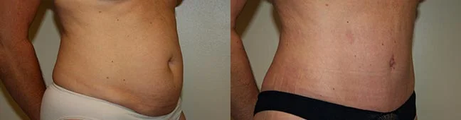 Before and after — Abdominoplasty