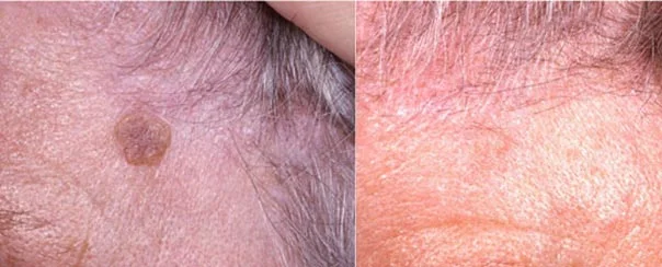 Before and after — Laser Resurfacing
