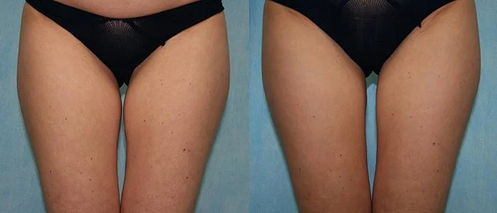 Before and after — CoolSculpting®
