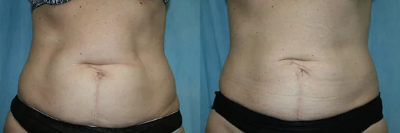 Before and after — CoolSculpting®