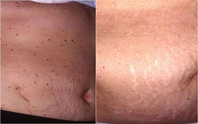 Before and after — Laser Resurfacing