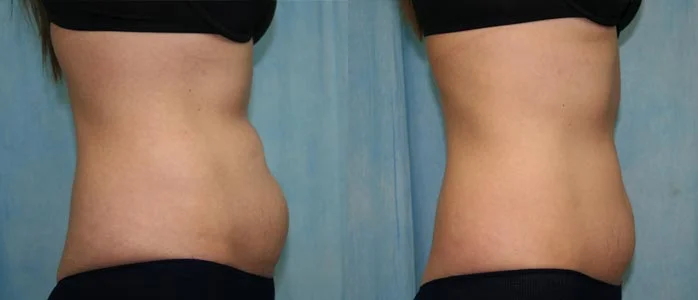 Before and after — CoolSculpting®