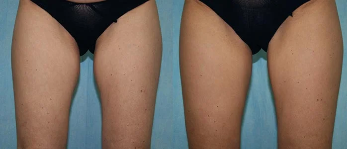 Before and after — CoolSculpting®