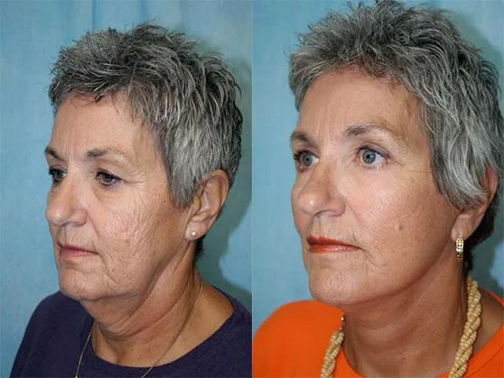 Before and after — Optimum LIFT™