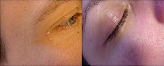 Before and after — Laser Resurfacing