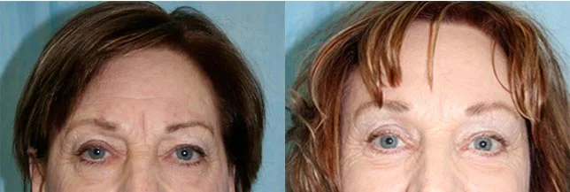 Before and after — Brow Lift