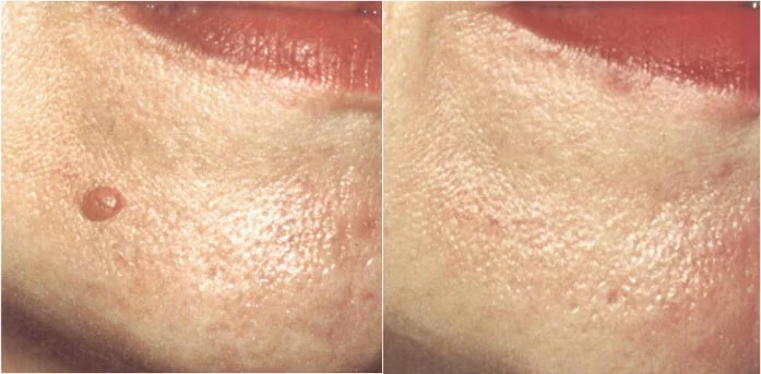 Before and after — Laser Resurfacing